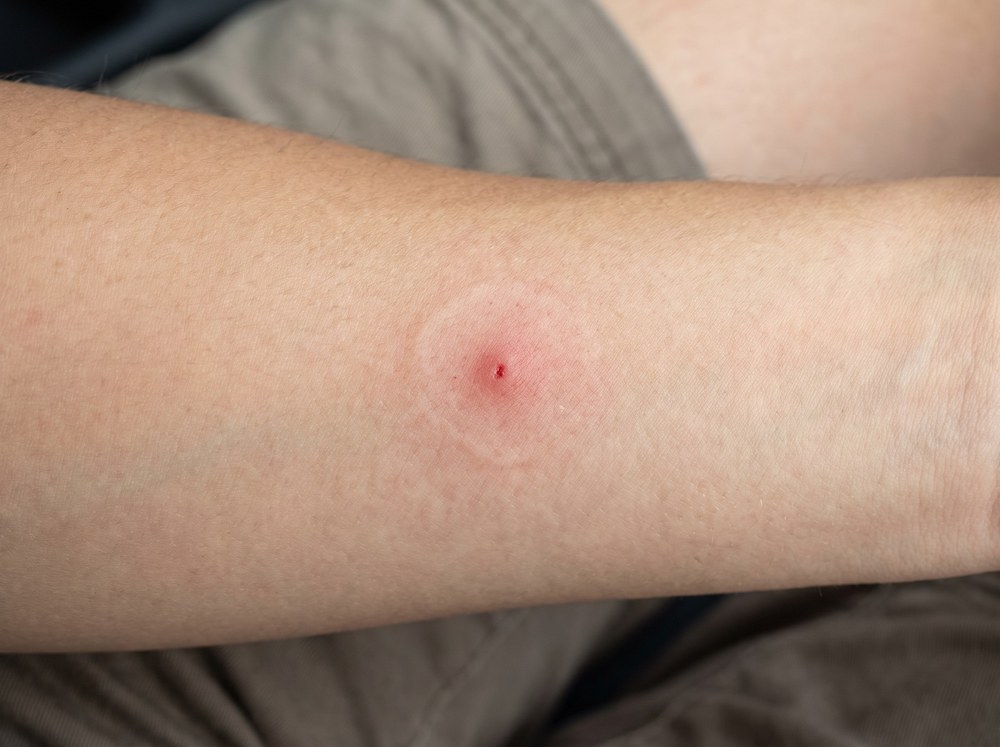 Close-up photo of a swollen red bite mark with a small central blister on human skin a few hours after a spider bite
