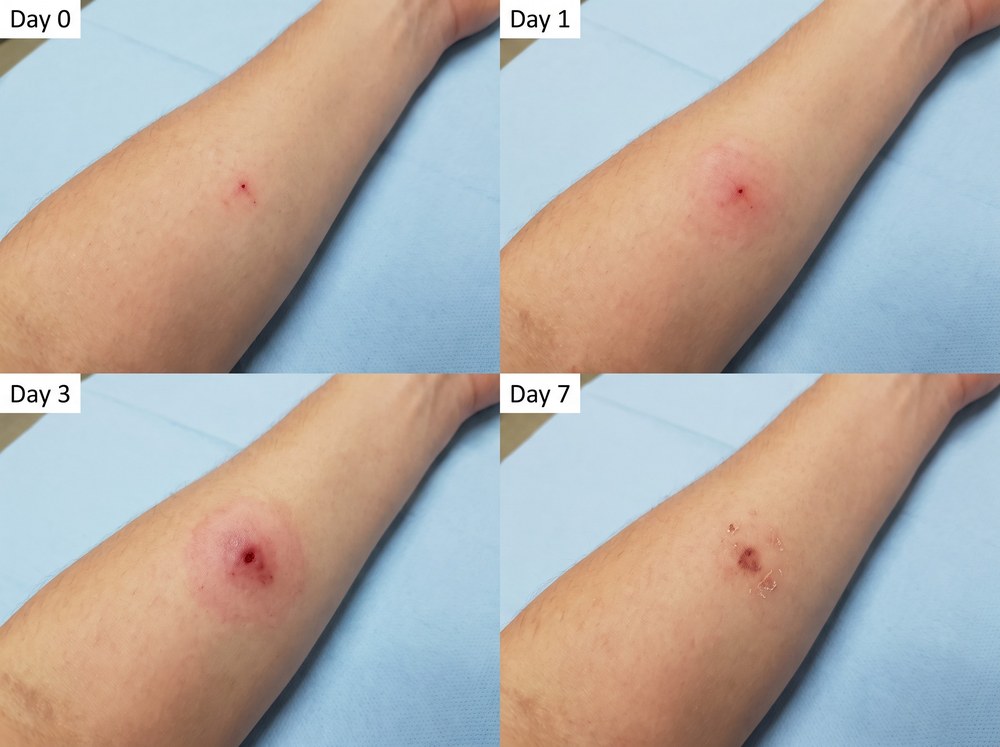Four-panel photo progression showing a spider bite mark healing from day zero through day seven with decreasing redness